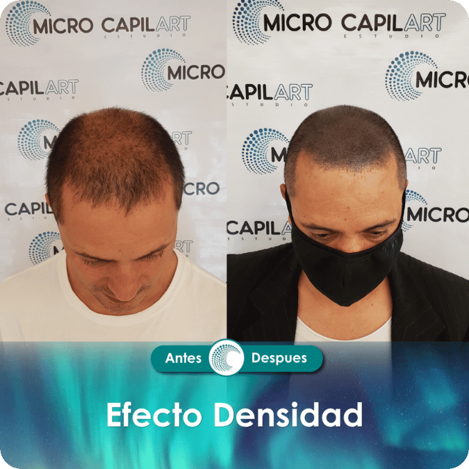 Micropigmentación capilar - Efecto Densidad
