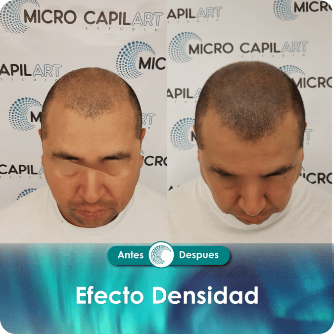 Micropigmentación capilar - Efecto Densidad