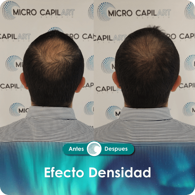 Micropigmentación capilar - Efecto Densidad