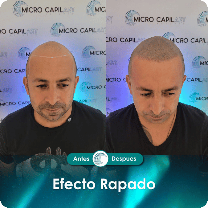 Micropigmentación capilar - Efecto Rapado