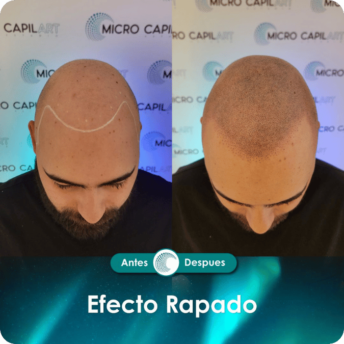 Micropigmentación capilar - Efecto Rapado