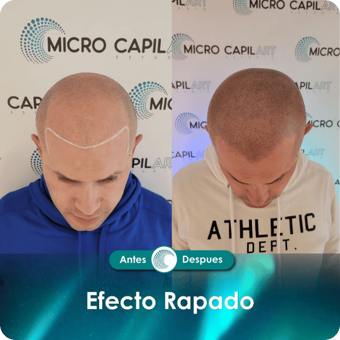 Micropigmentación capilar - Efecto Rapado