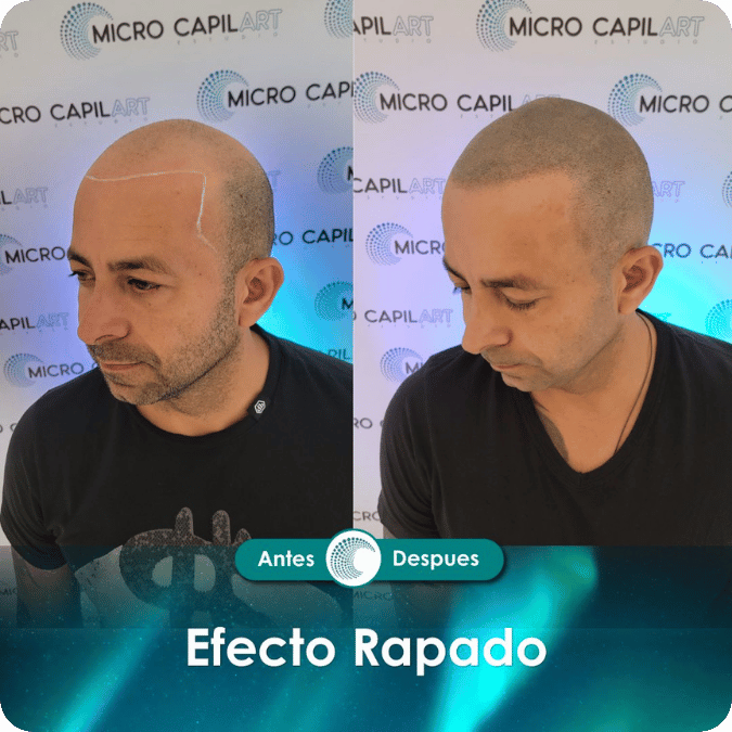 Micropigmentación capilar - Efecto Rapado