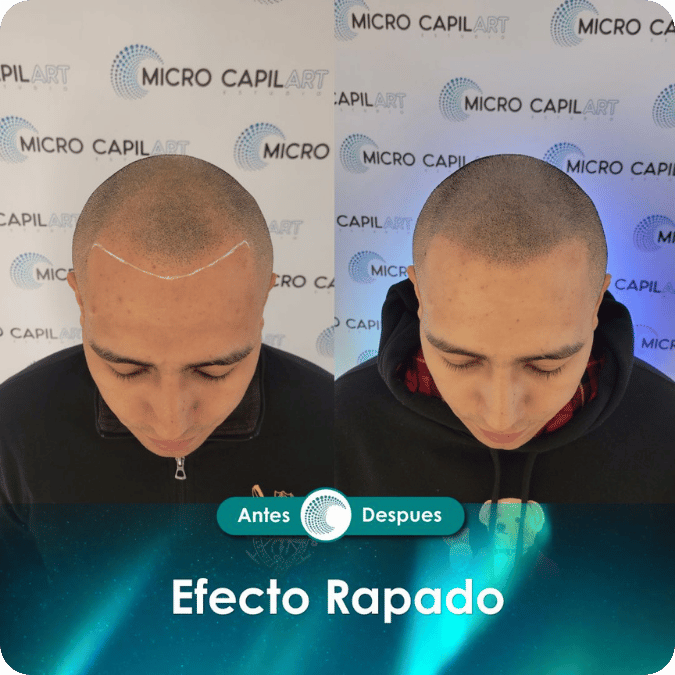 Micropigmentación capilar - Efecto Rapado