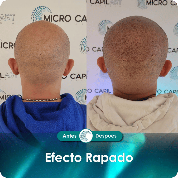 Micropigmentación capilar - Efecto Rapado