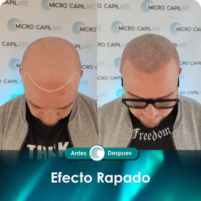 Micropigmentación capilar - Efecto Rapado