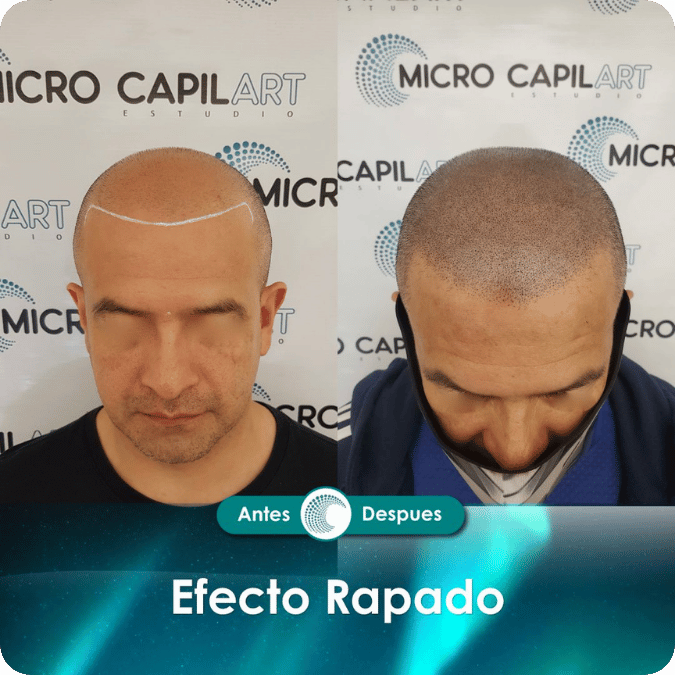 Micropigmentación capilar - Efecto Rapado