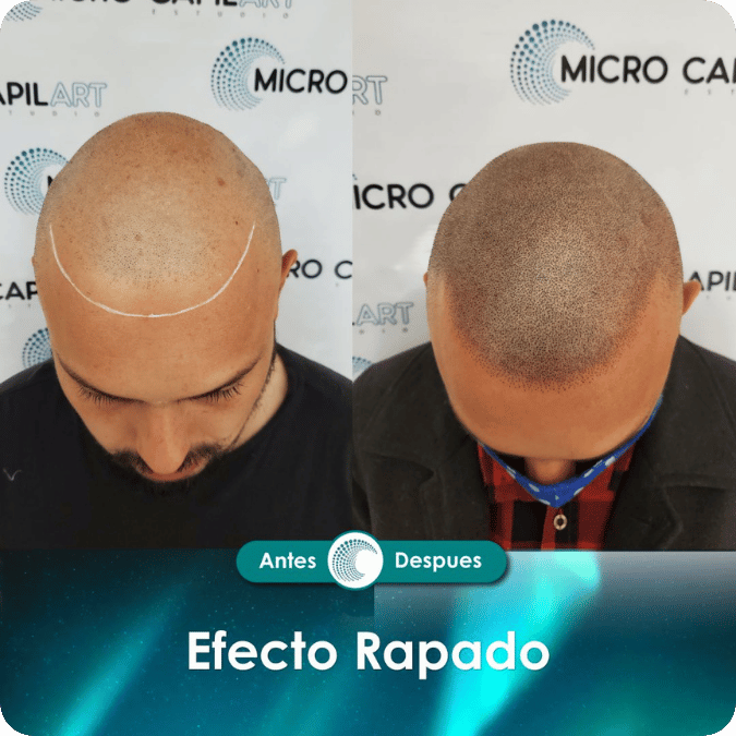 Micropigmentación capilar - Efecto Rapado