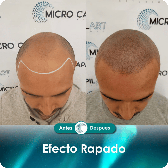 Micropigmentación capilar - Efecto Rapado