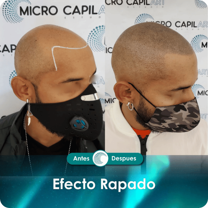 Micropigmentación capilar - Efecto Rapado