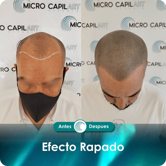 Micropigmentación capilar - Efecto Rapado
