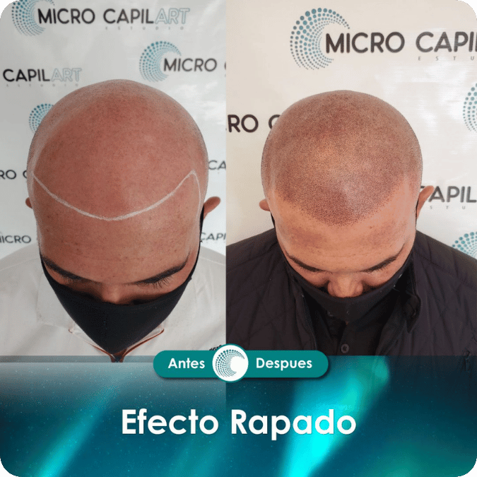 Micropigmentación capilar - Efecto Rapado