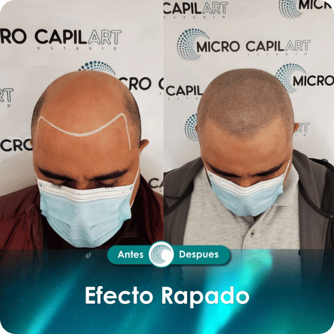 Micropigmentación capilar - Efecto Rapado