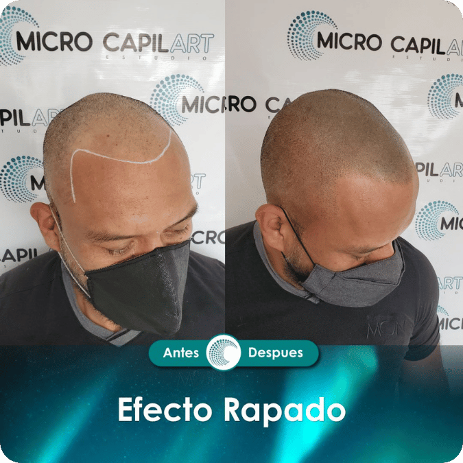 Micropigmentación capilar - Efecto Rapado