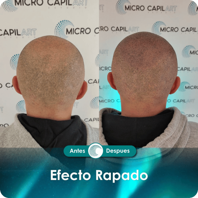 Micropigmentación capilar - Efecto Rapado