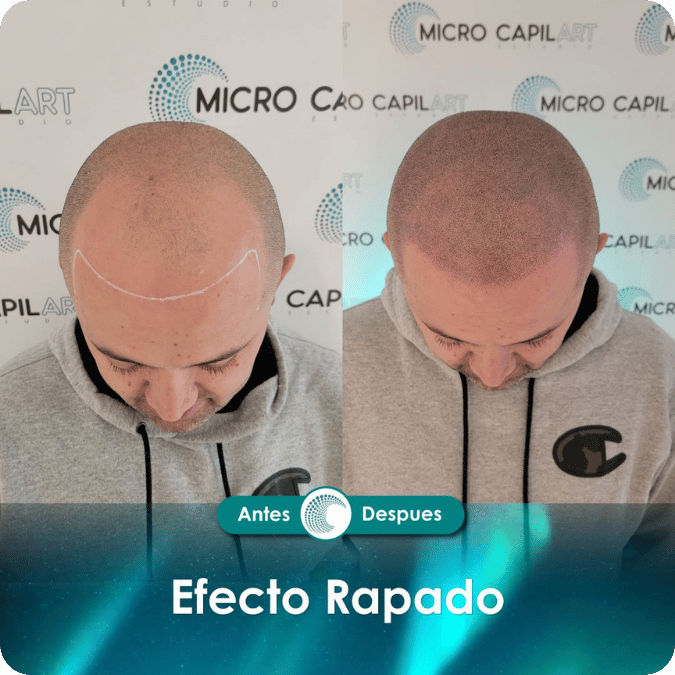 Micropigmentación capilar - Efecto Rapado