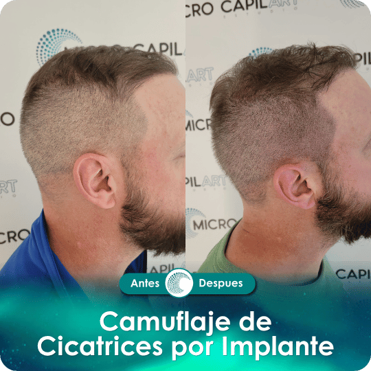 Camuflaje de cicatriz - Caso 3