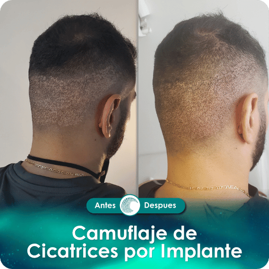 Camuflaje de cicatriz - Caso 1