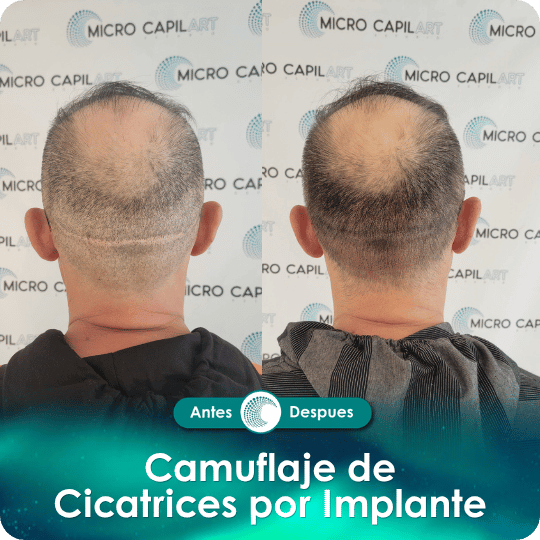 Camuflaje de cicatriz - Caso 4
