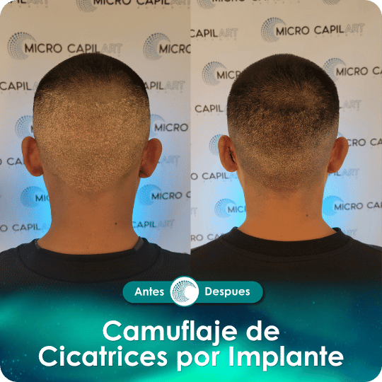 Camuflaje de cicatriz - Caso 2