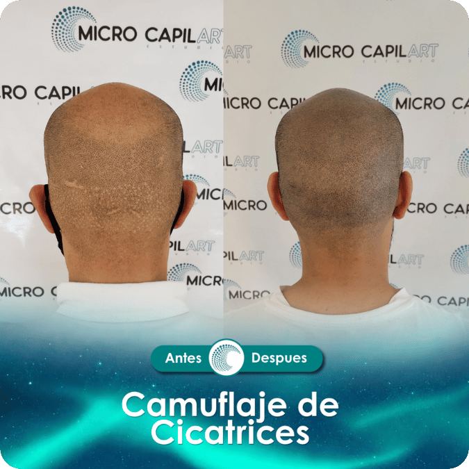 Camuflaje de cicatriz - Caso 8