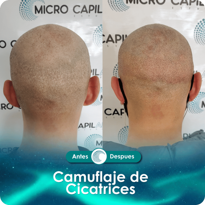 Camuflaje de cicatriz - Caso 10