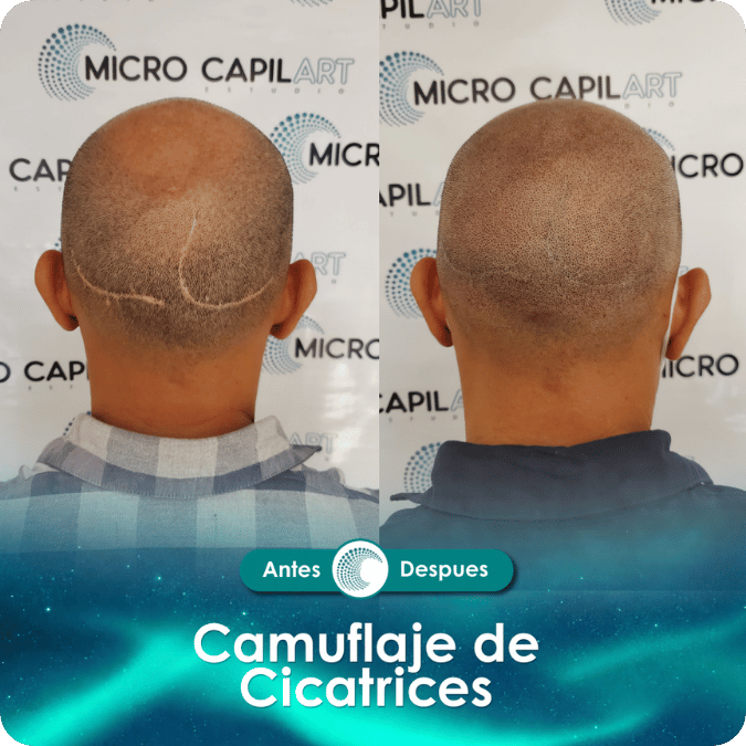 Camuflaje de cicatriz - Caso 9