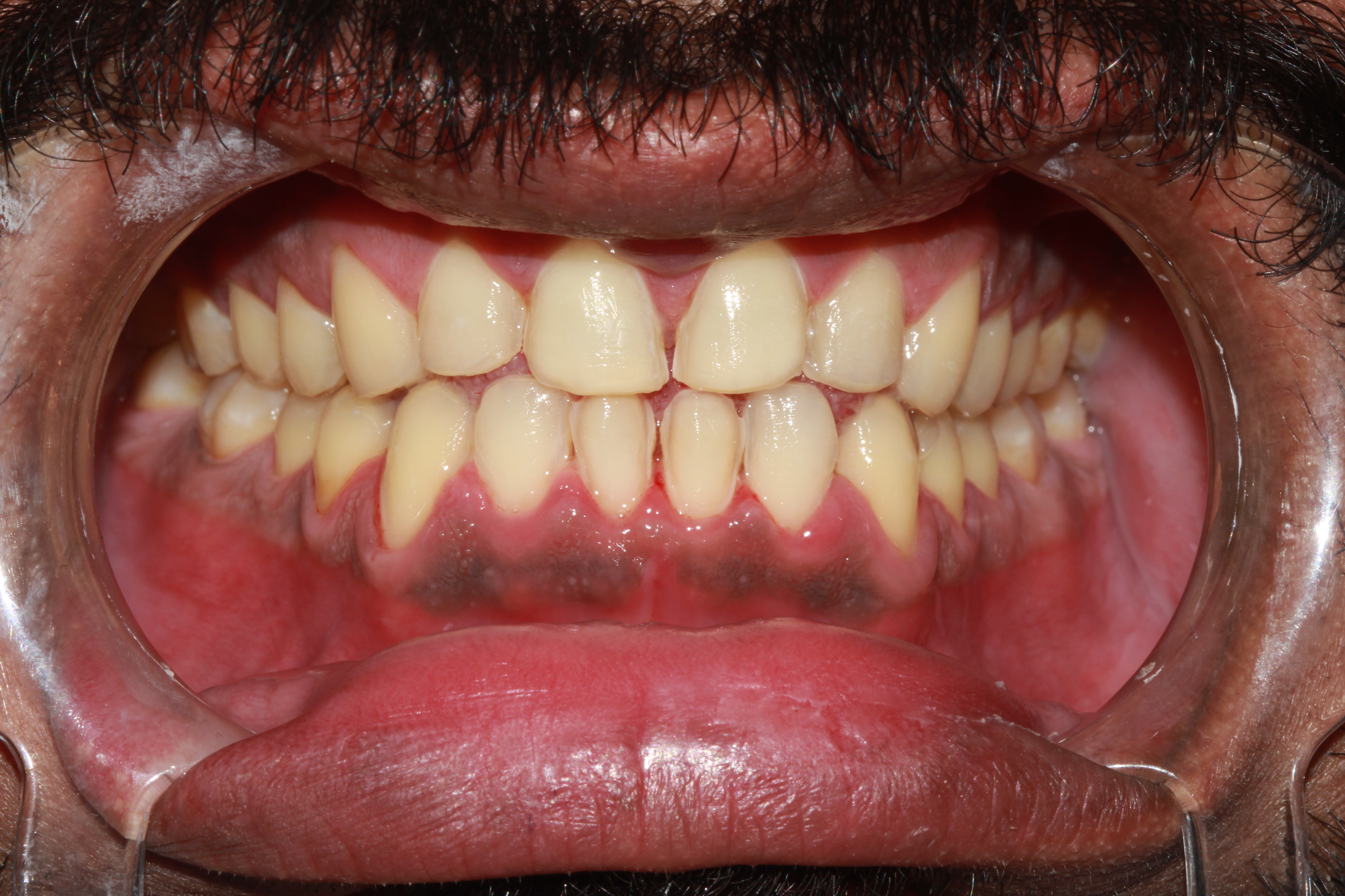 Before Veneers
