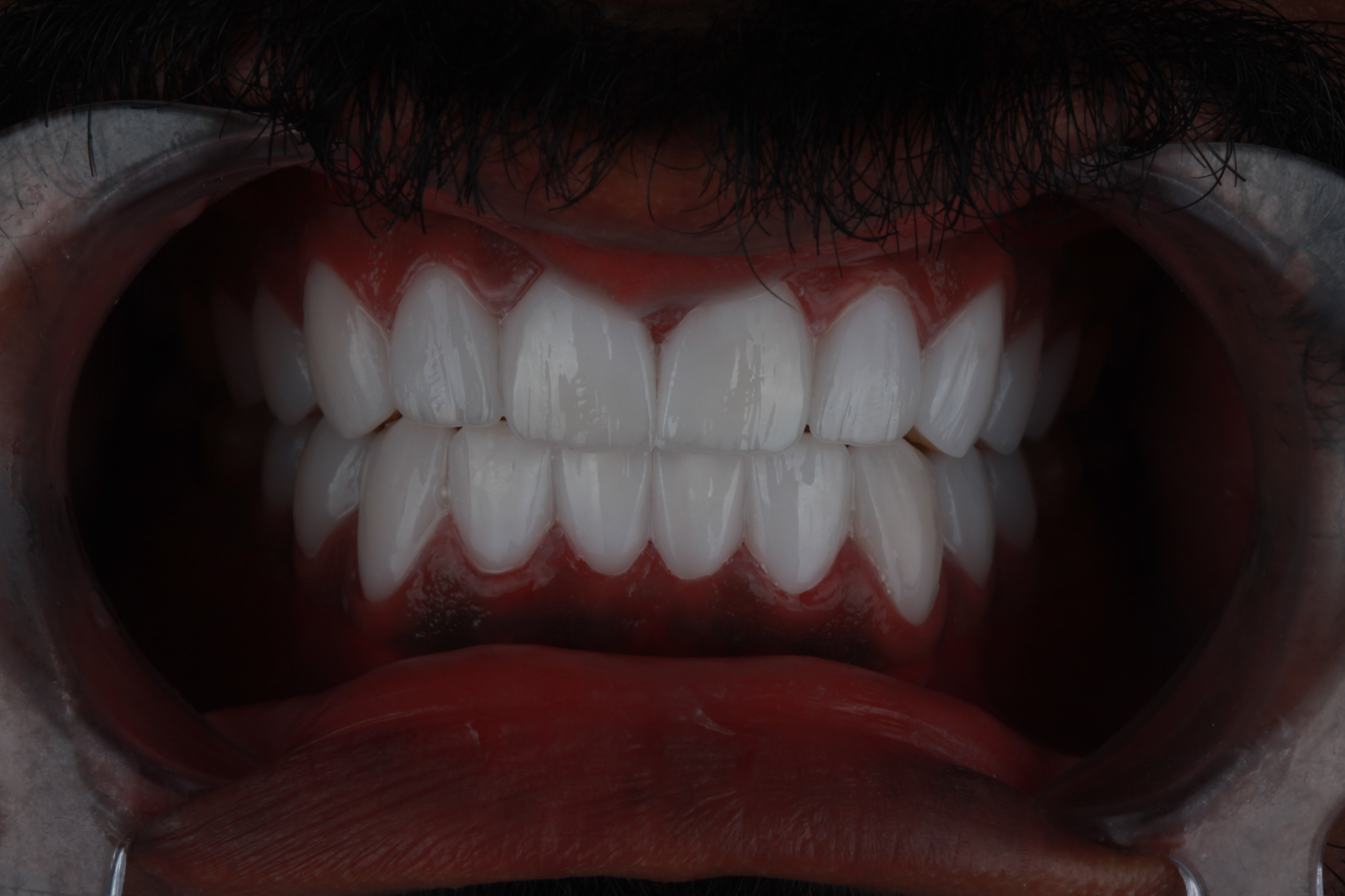After Veneers