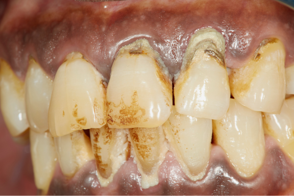 gum disease and decay Grand Junction