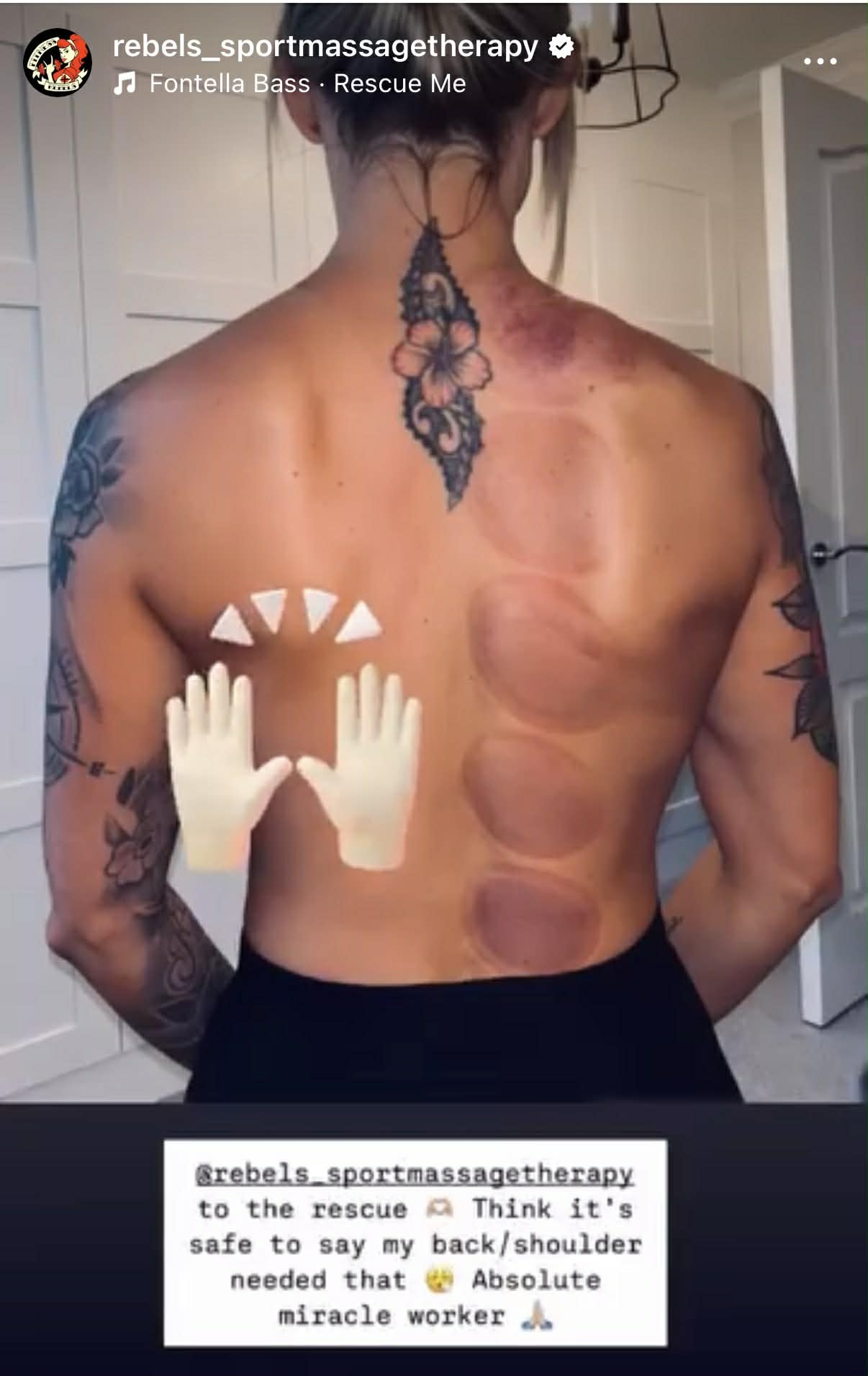 Cupping therapy marks on a client's back — Rebels Sports Massage, Knottingley