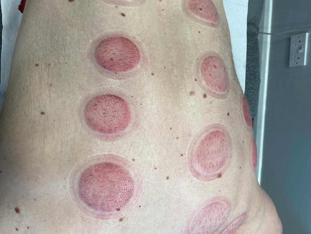 Dry cupping therapy on a client's back — Rebels Sports Massage, Knottingley