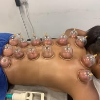 Dry cupping therapy on back — Rebels Sports Massage, Knottingley