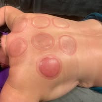 Dry cupping marks on back — Rebels Sports Massage, Knottingley