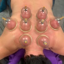 Dry cupping marks on back — Rebels Sports Massage, Knottingley
