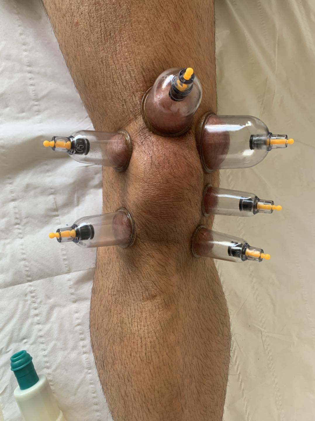 Dry cupping therapy on leg — Rebels Sports Massage, Knottingley