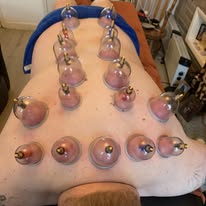 Dry cupping therapy on back — Rebels Sports Massage, Knottingley