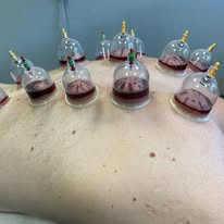 Hijama wet cupping therapy on back — Rebels Sports Massage, Knottingley