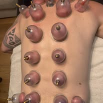 Dry cupping therapy on back — Rebels Sports Massage, Knottingley