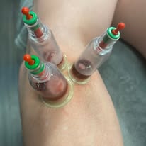 Hijama wet cupping therapy on leg — Rebels Sports Massage, Knottingley