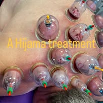 Hijama wet cupping therapy on back — Rebels Sports Massage, Knottingley