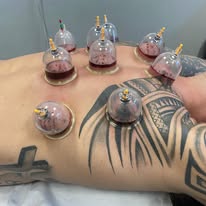 Hijama wet cupping therapy on back — Rebels Sports Massage, Knottingley