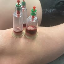 Hijama wet cupping therapy on leg — Rebels Sports Massage, Knottingley