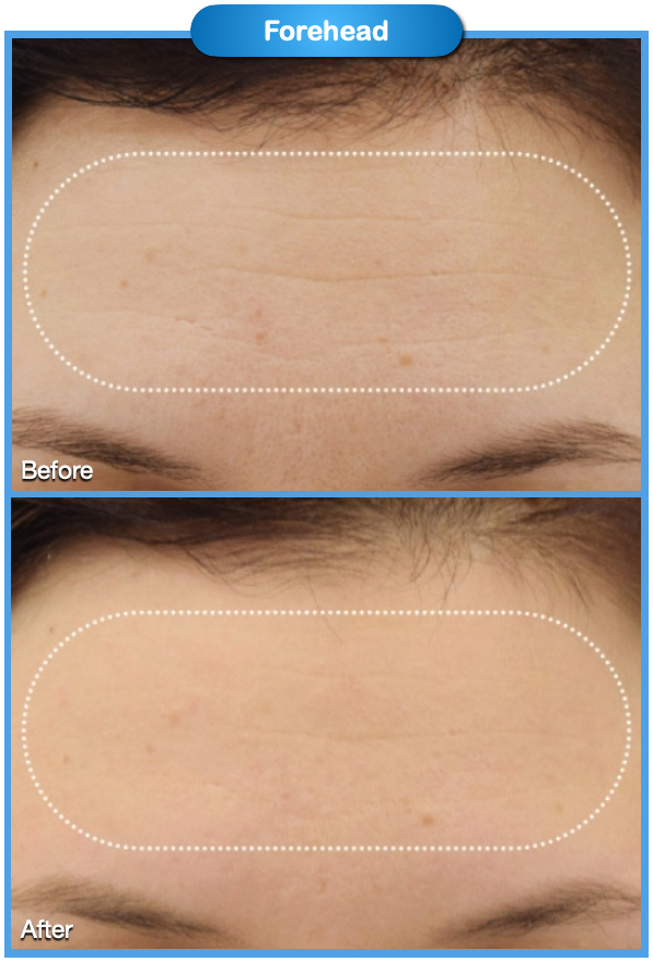 Forehead Before and After