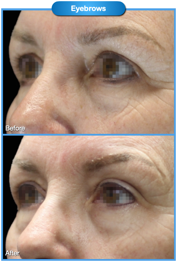Eyebrows Before and After