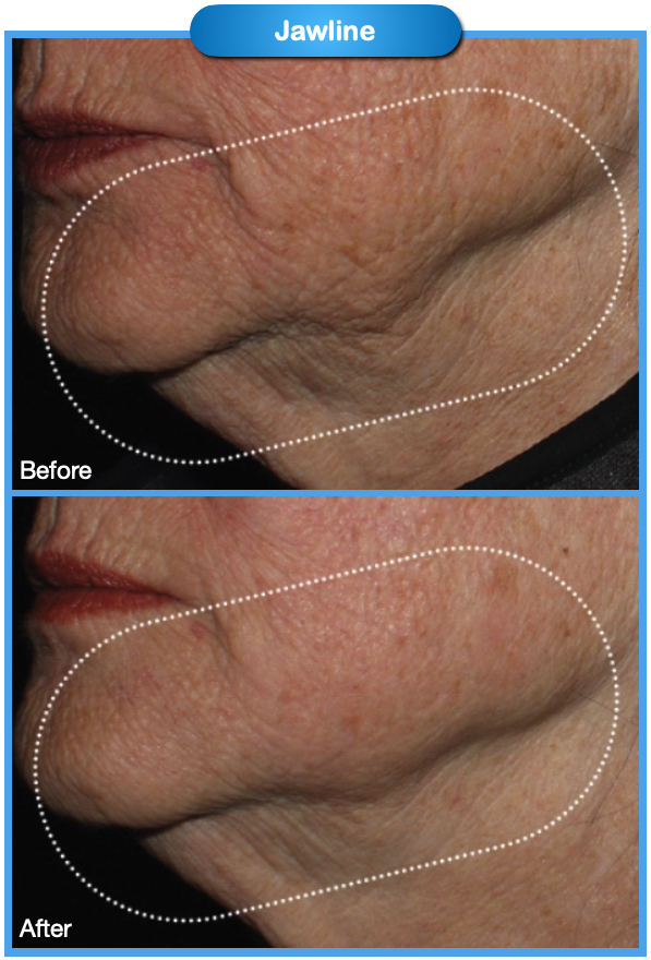 Jawline Before and After