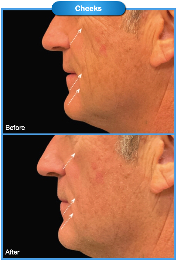Cheeks Before and After