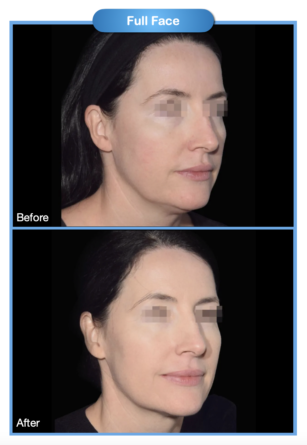 Full Face Before and After