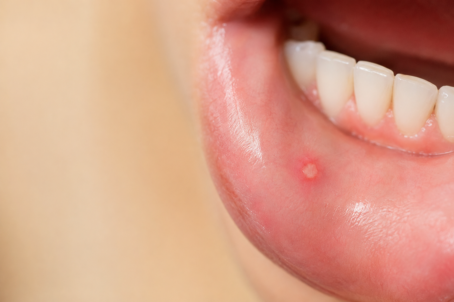 pain for mouth sores