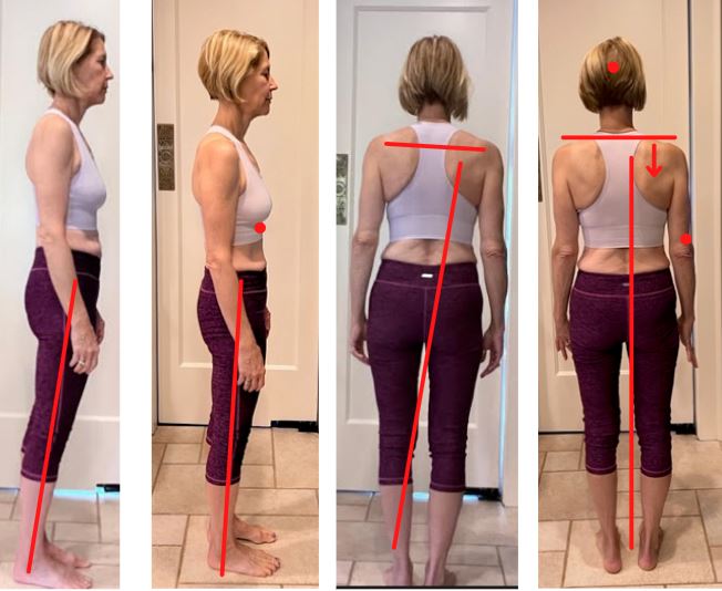 Evey: Hip Strength & Balance After Hip Replacement Evey: Hip Strength & Balance After Hip Replacement